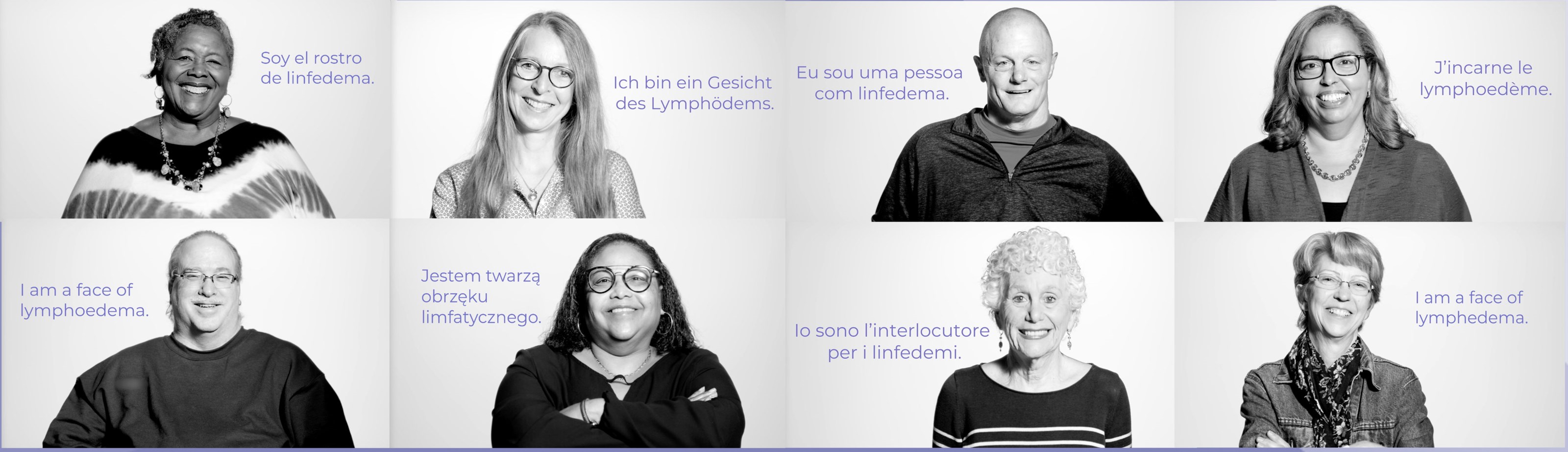 Lymphedema has many faces