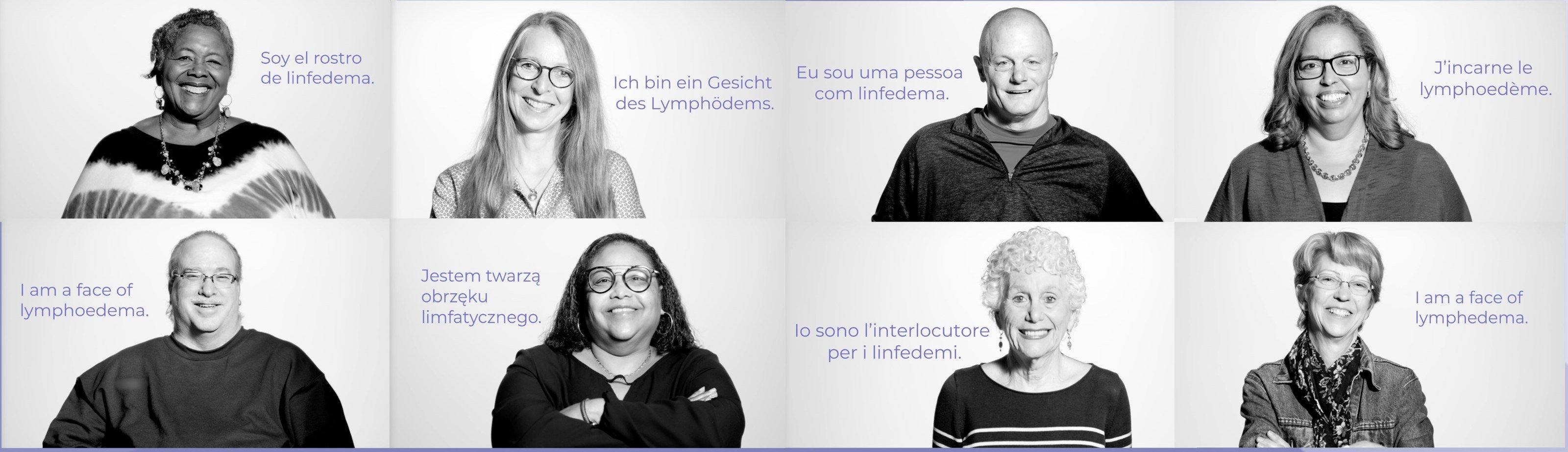 Lymphedema has many faces